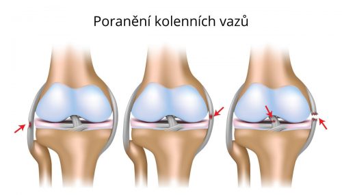 poraneni-kolennich-vazu
